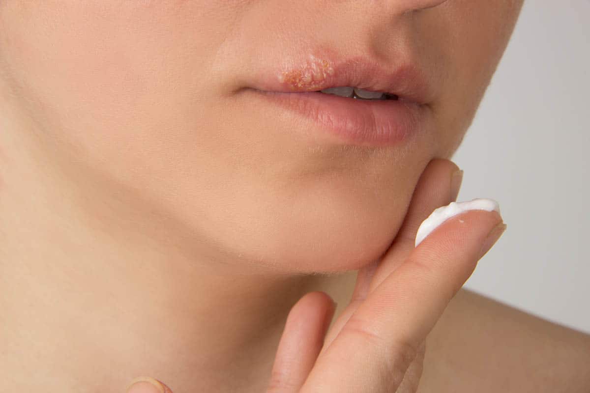 a woman learning how to get rid of a cold sore
