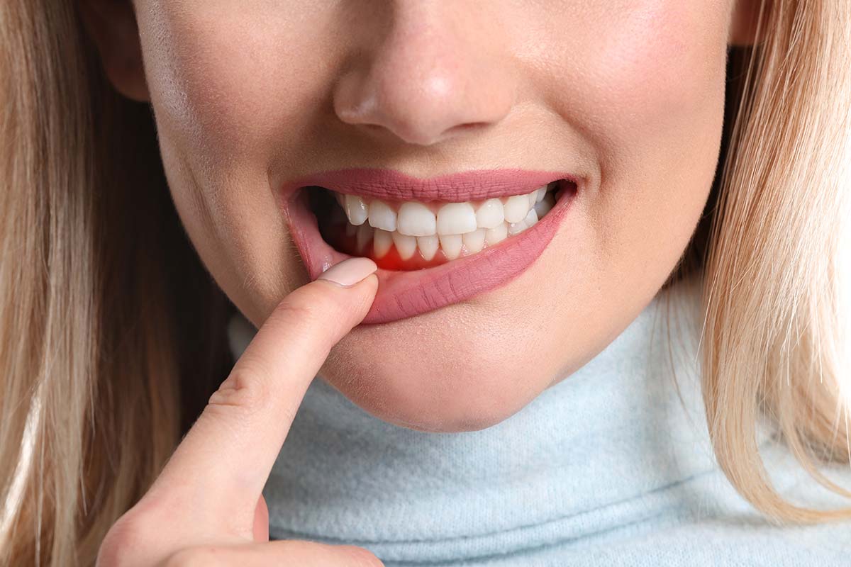 woman pulling down her lip to show swollen gums asking what is gingivitis